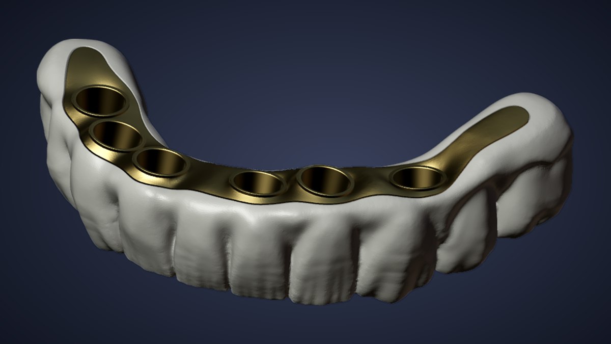 Híbrida full arch con barra de titanio, diseño del laboratorio